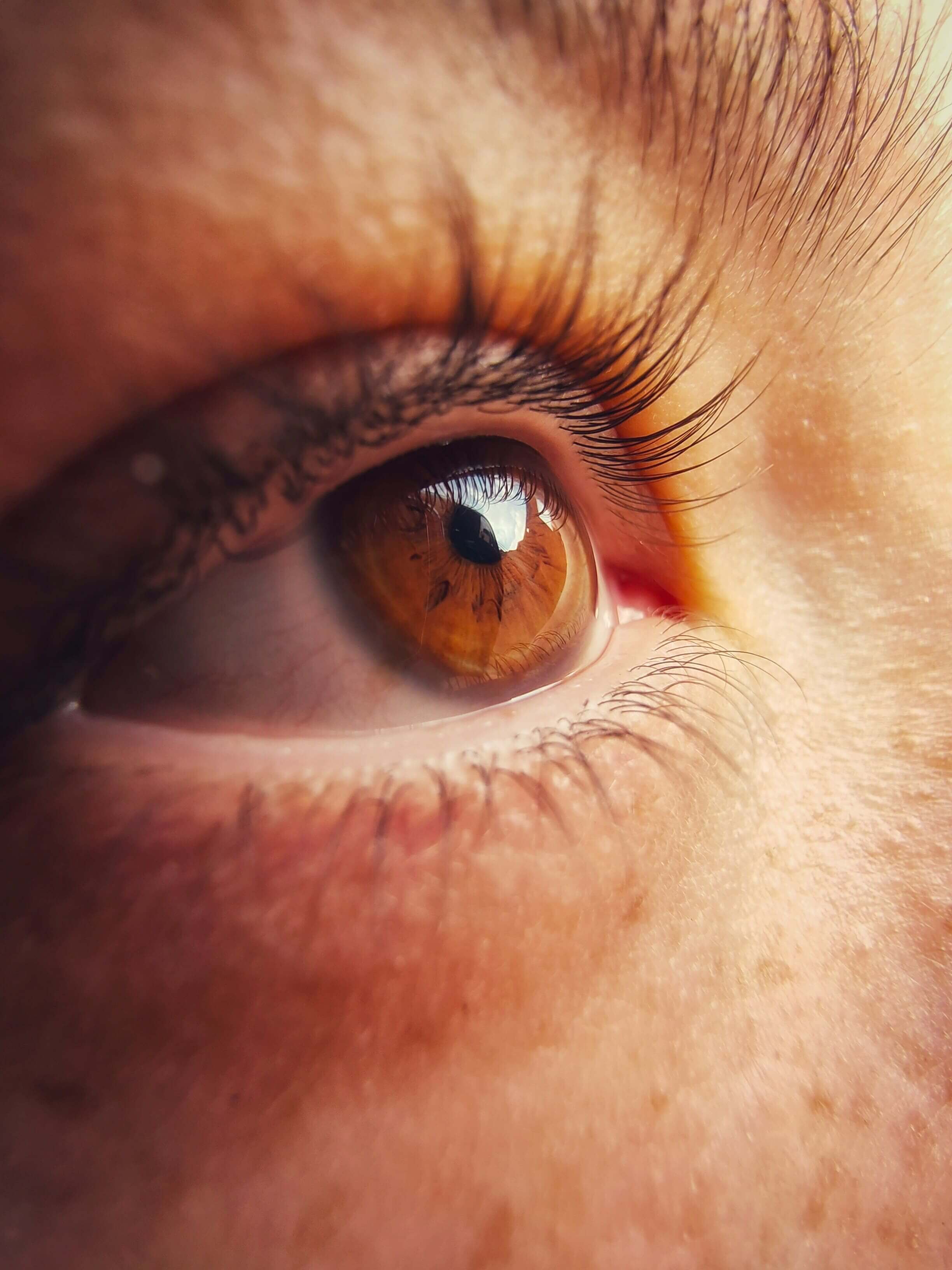 눈밑지방 제거수술 비용, 눈밑 주름 없애는 방법