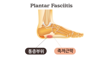 족저근막염 이미지