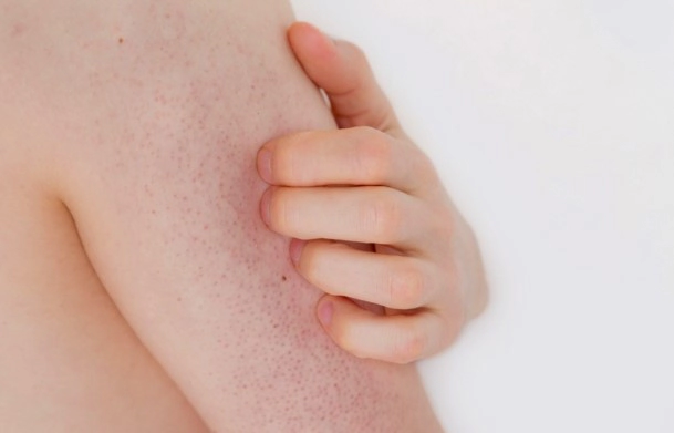 모공각화증 자주묻는질문 FAQ