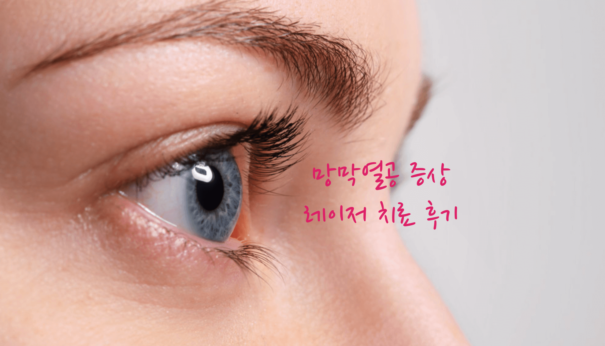 망막열공 증상