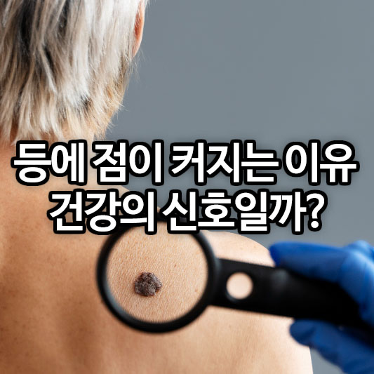 등에 점이 커지는 이유, 건강의 신호일까?
