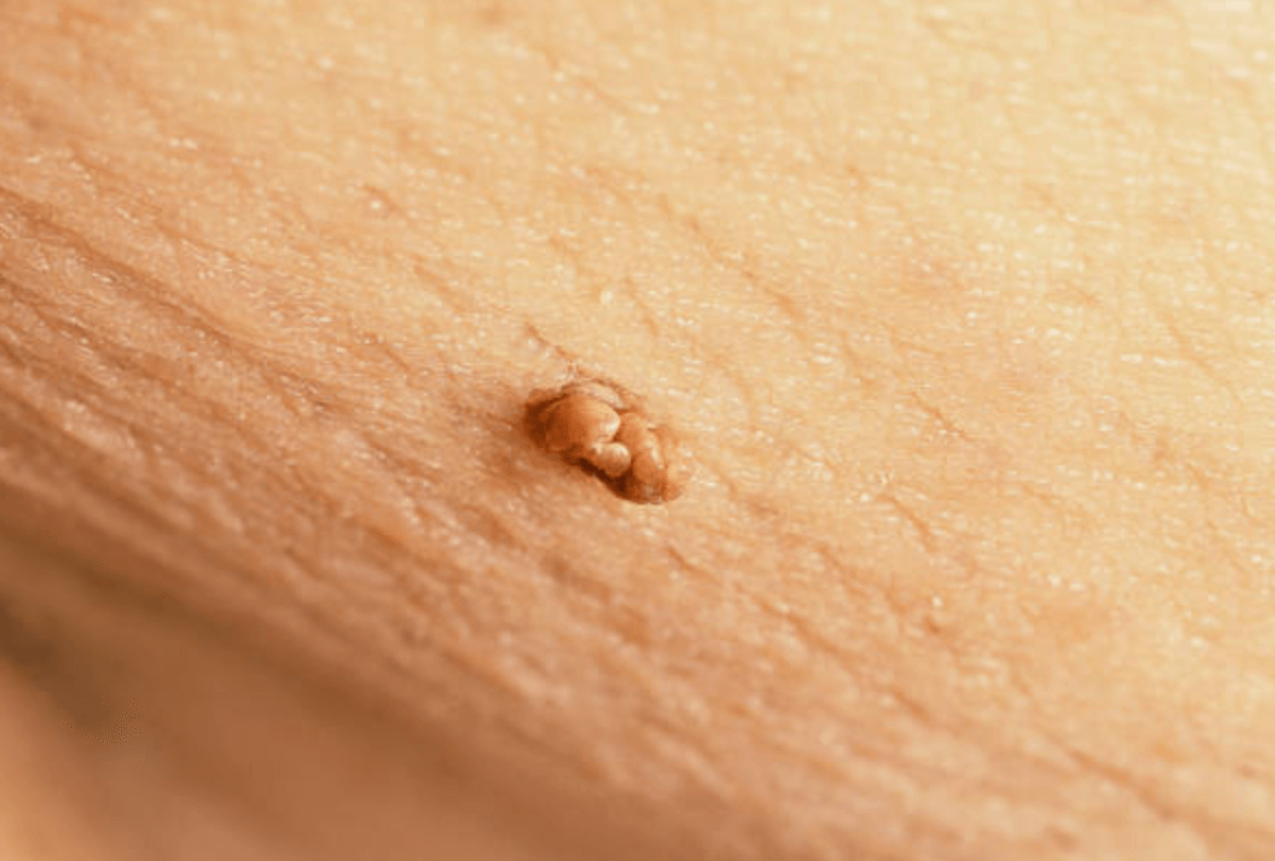 쥐젖 제거 방법