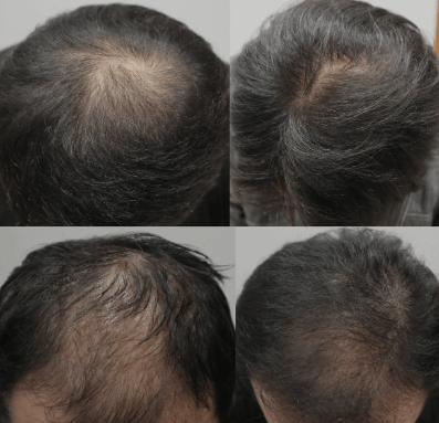 탈모 원인과 예방법, 탈모 예방 샴푸