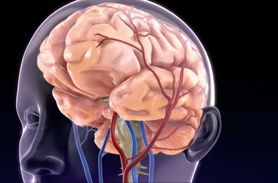 뇌경색 전조증상