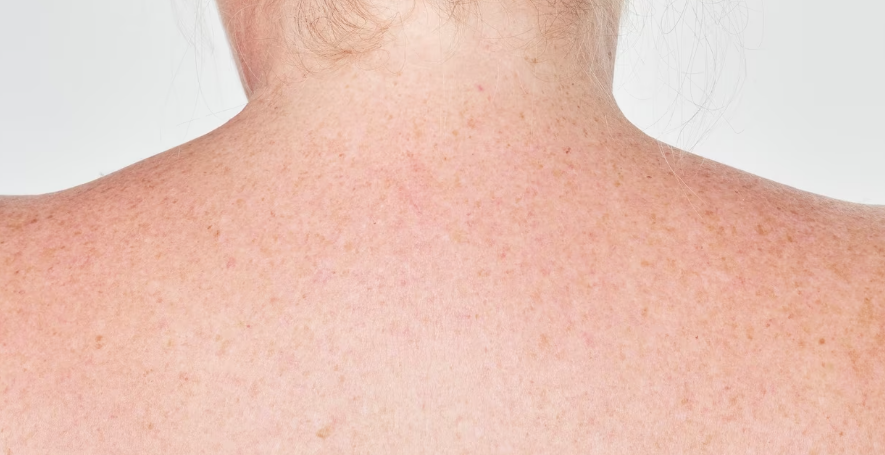 모공각화증 방치하지 말고 치료해요