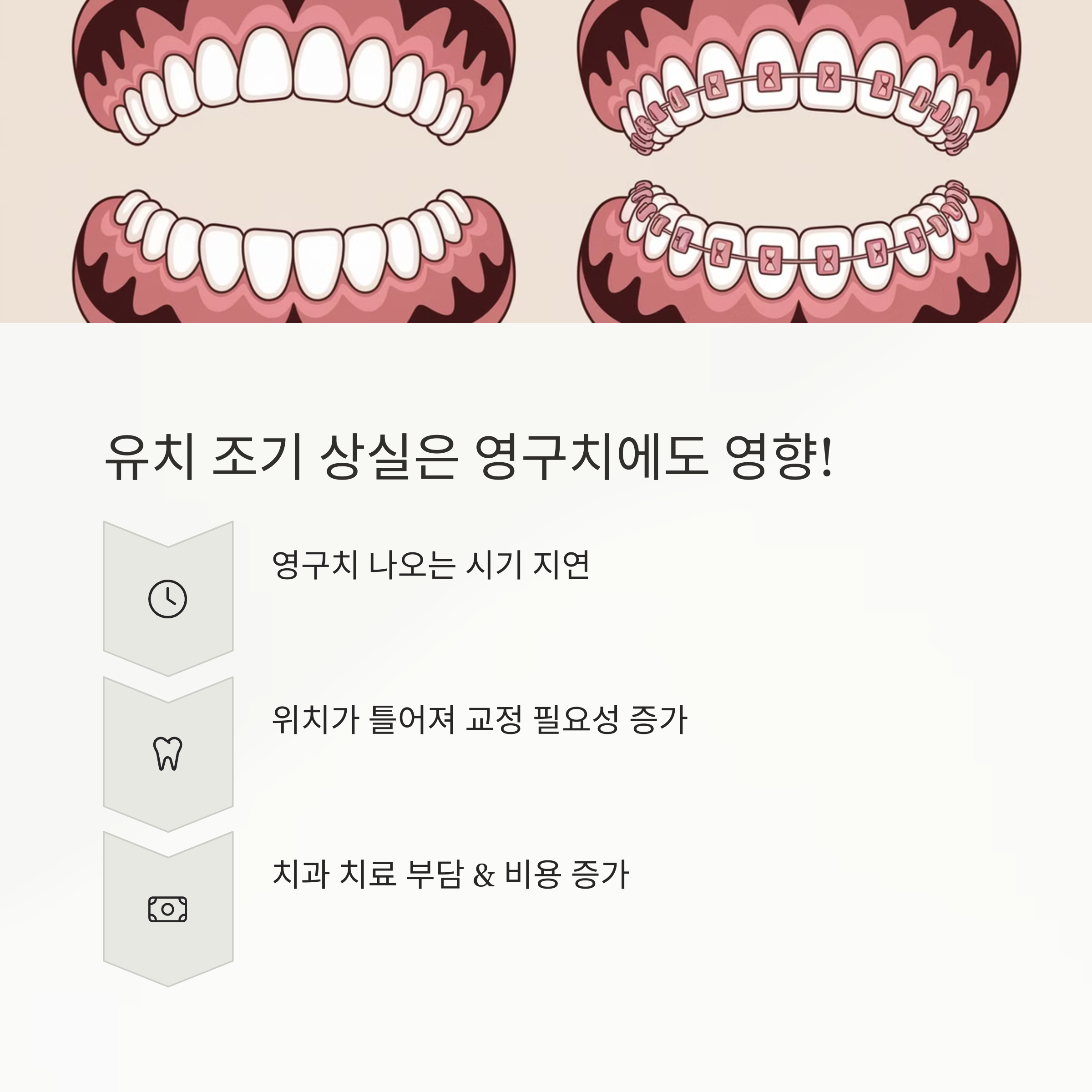 유치 조기 상실 – 영구치 지연, 교정 필요성 증가, 치과 비용 부담 정리