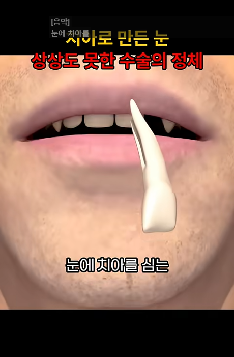 치아를 이용해 눈 수술을 한다는 이미지