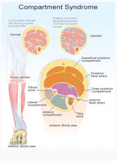 만성구획증후군