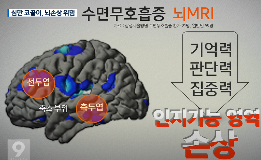 수면무호흡이 뇌손상을 일이키는 증거