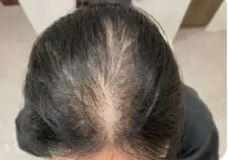 환절기 머리카락이 더 빠지는 이유와 해결책