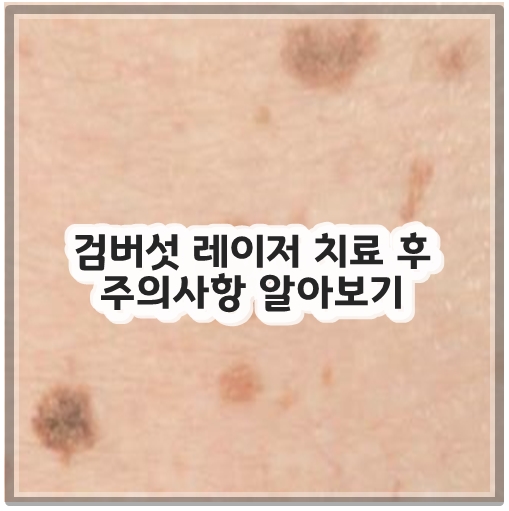 검버섯 레이저 치료 후 주의사항 알아보기