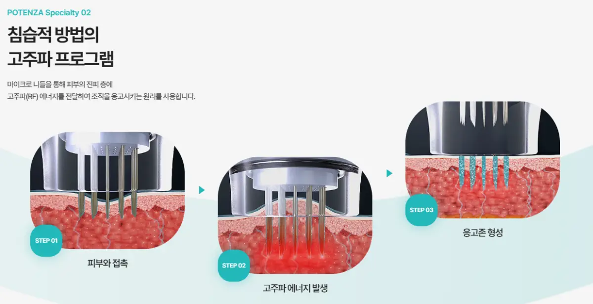 포텐자-침습형-원리