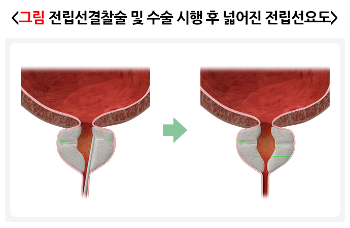 전립선결찰술-및-수술-시행-후-넓어진-전립선요도를-표현한-그림