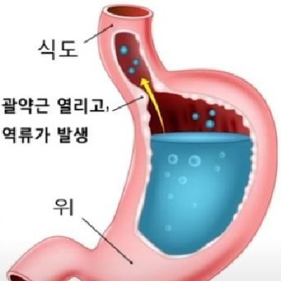 역류성 식도염