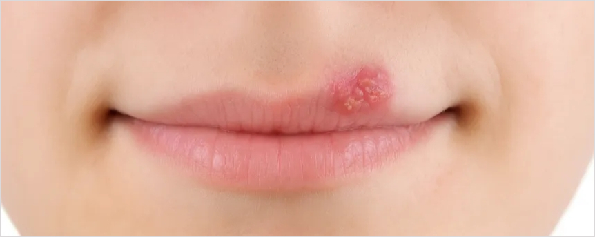 헤르페스 입술