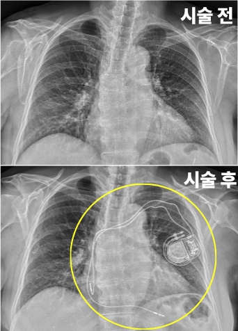 부정맥-종류에-따른-치료법-비교