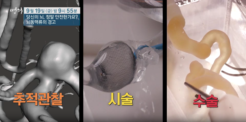 명의/ 당신의 뇌, 정말 안전한가요? - 뇌동맥류의 경고