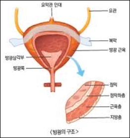 방광암 초기증상 -3