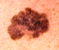 흑색종(Melanoma)