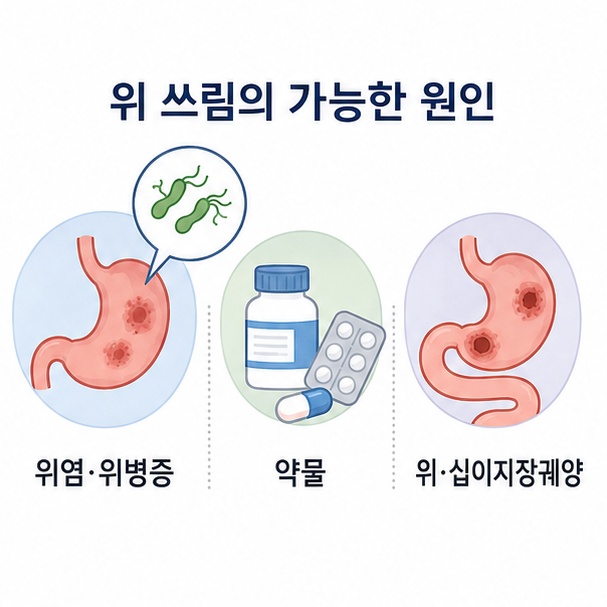 위염과 위궤양, 헬리코박터균, 소염진통제 등 위 쓰림을 일으킬 수 있는 원인을 정리한 이미지