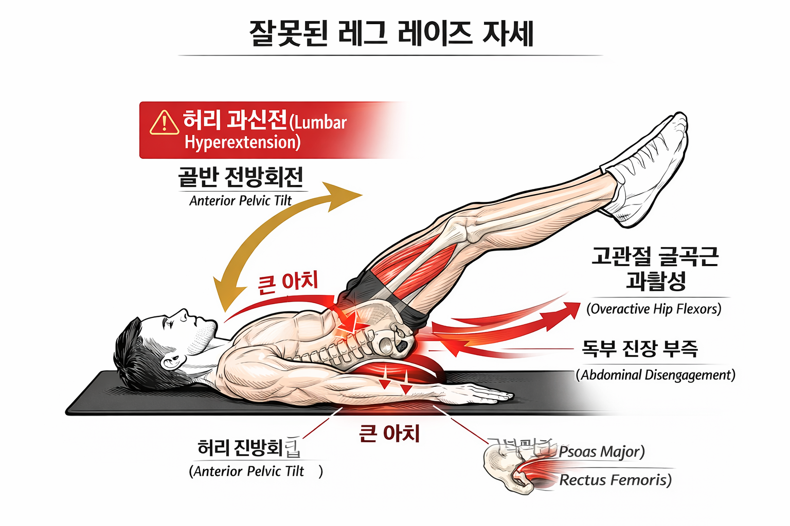 레그레이즈 허리 과신전 잘못된 하복부 운동 자세