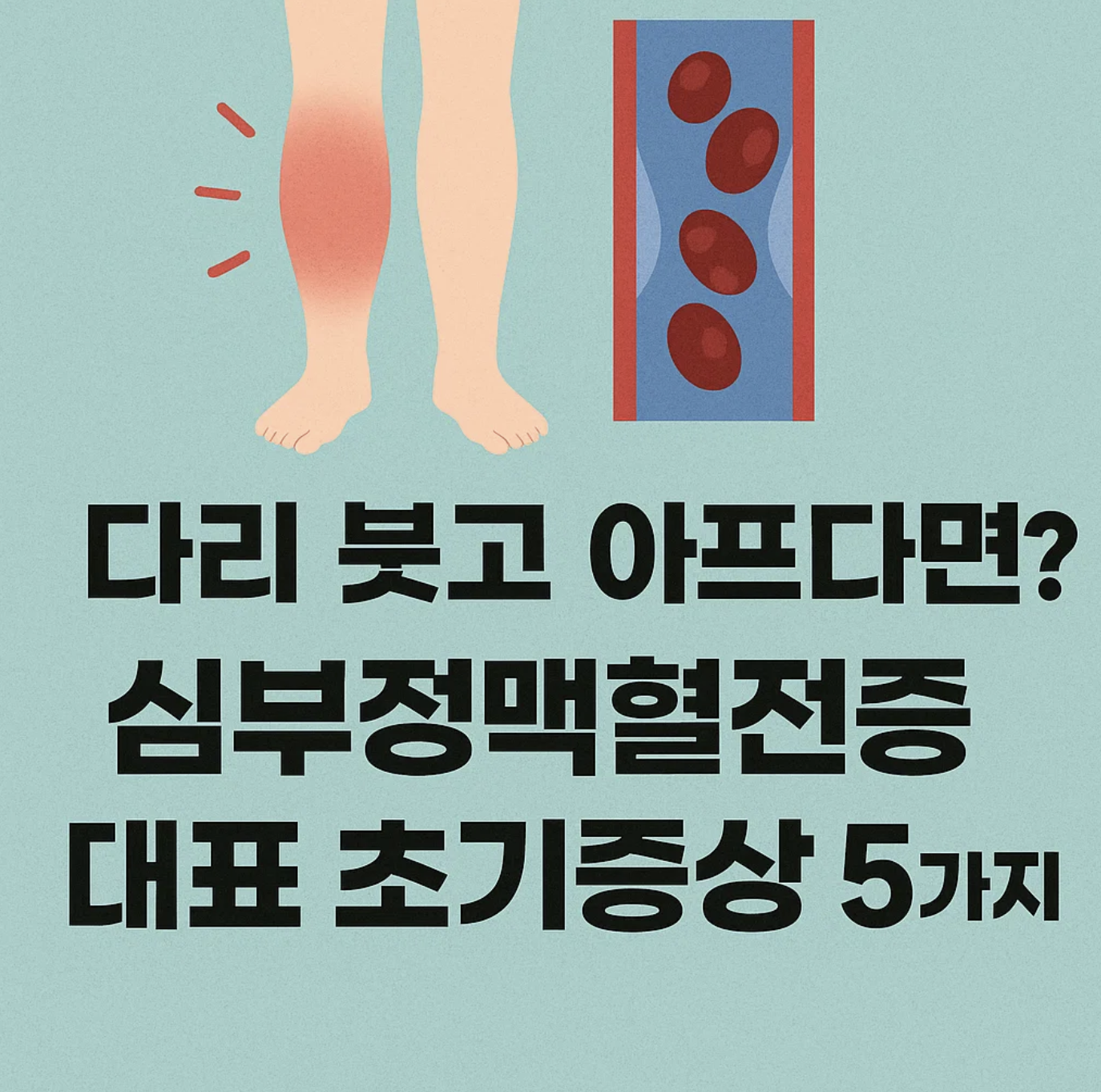 다리 붓고 아프다면? 심부정맥혈전증 대표 초기증상 5가지