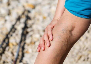 하지정맥류-수술비용