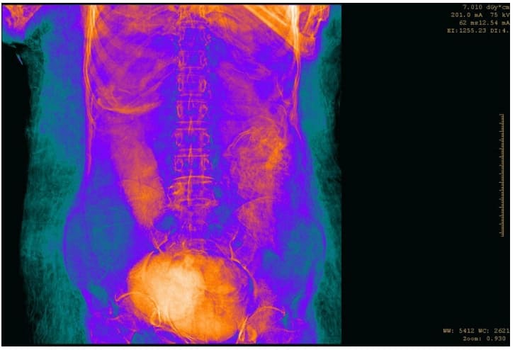 세계 최초 임신 미이라 공개 VIDEO: A Closer Look at the World's First Pregnant Egyptian Mummy