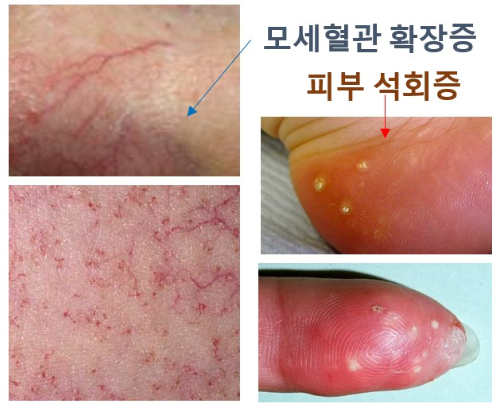 레이노 증후군 피부 석회증, 모세혈관 확장증