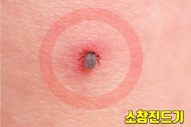 전신 관절통 원인 라임병