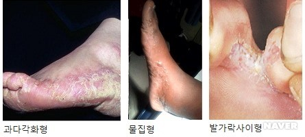 무좀 유형