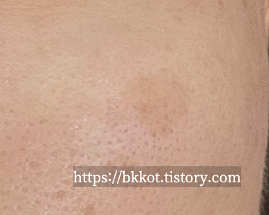 리팟레이저 후기