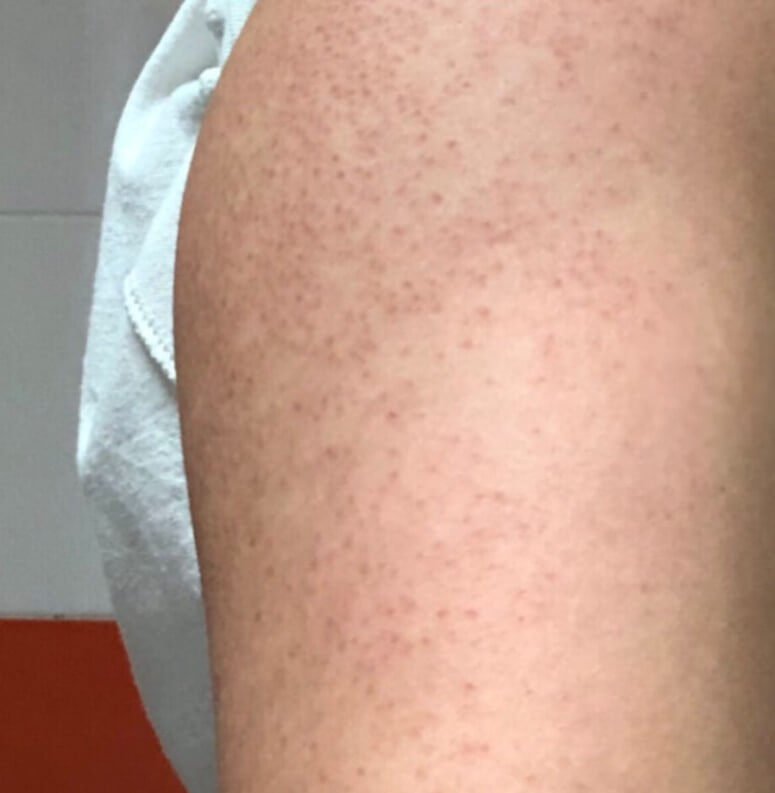 팔뚝에 생긴 모공각화증 증상