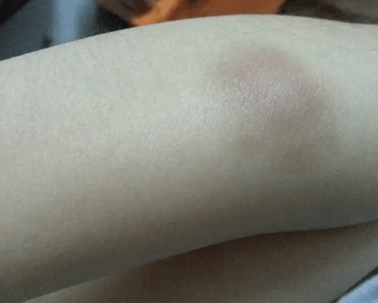 팔에-생긴-멍