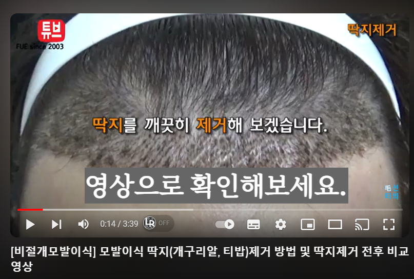 모발이식_개구리알