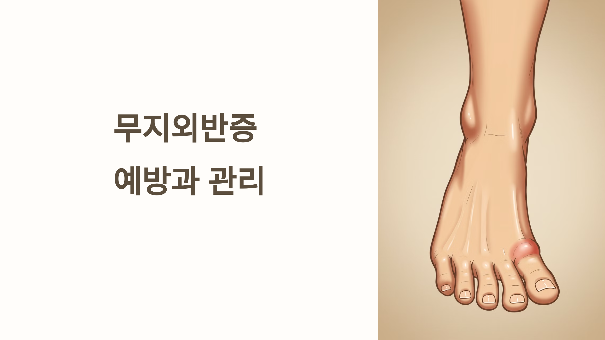 무지외반증 예방과 관리