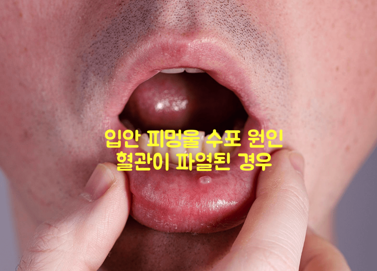 입안 피멍울