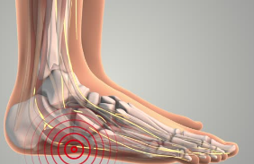 족저 신경 압박