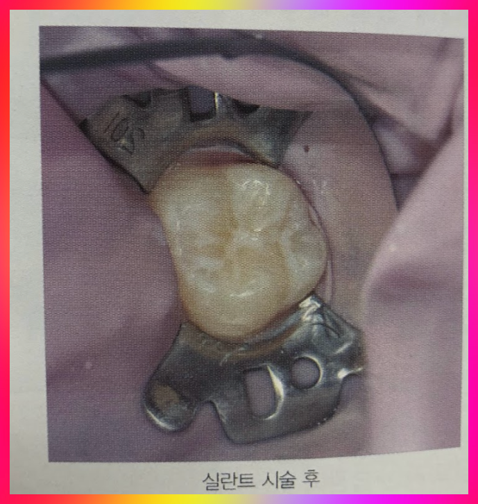 실란트 치료 후 사진 모습