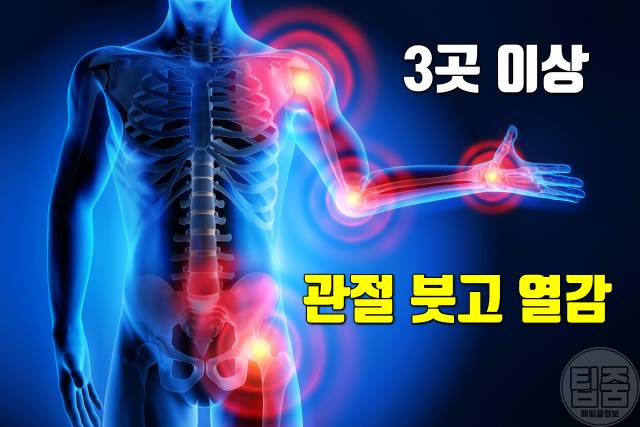 류마티스 관절염 초기 증상 자가진단 관절 붓고 열감