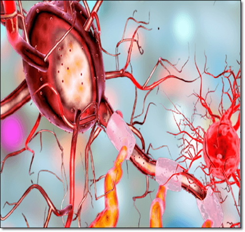 비문증 원인이 되는 안구 출혈 이미지
