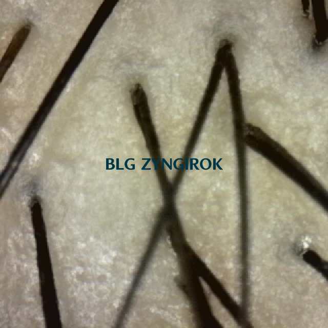 탈모 극복프로젝트 - 피나모아 복용 - 정수리 두피사진 모습이다.