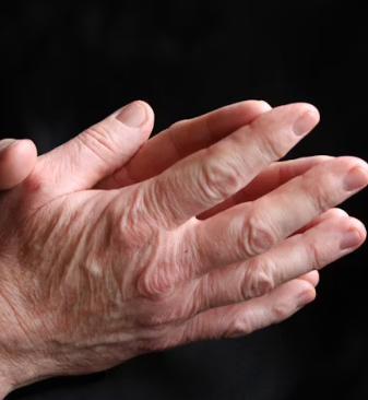 건선 초기 증상 피부염 원인 치료방법