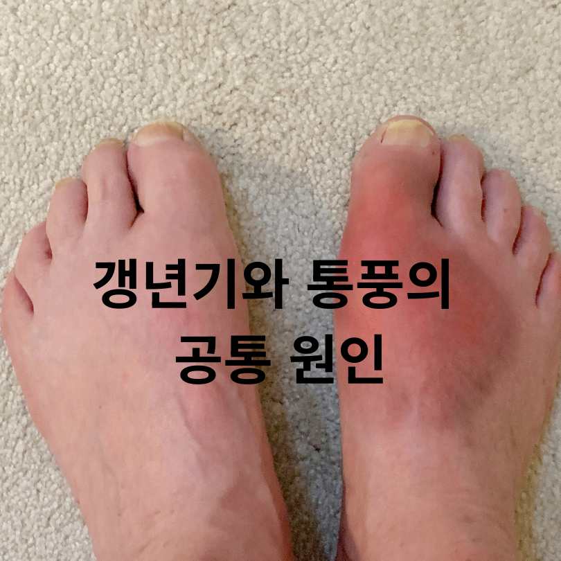 갱년기 통풍 증상과 원인&amp;#44; 예방하는 식습관 꿀팁