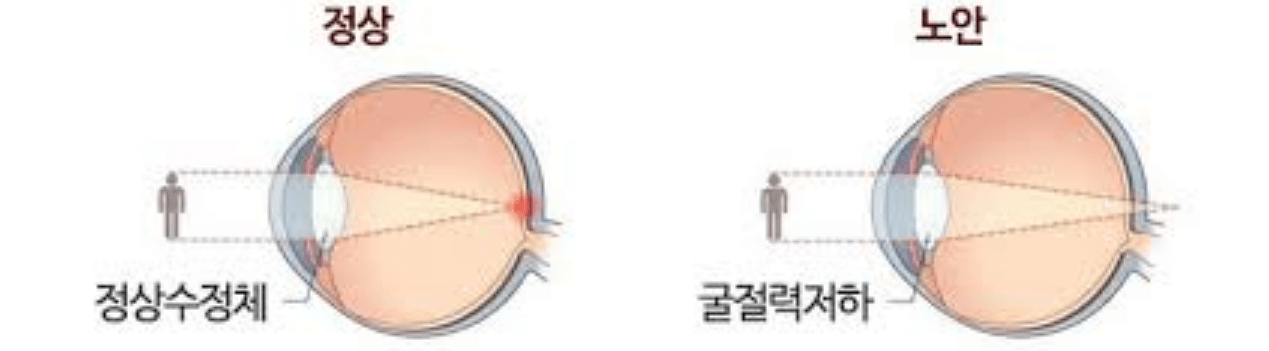 노안-정상인-수정체-비교-사진