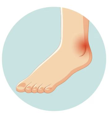 통풍 빨리 낫는 방법