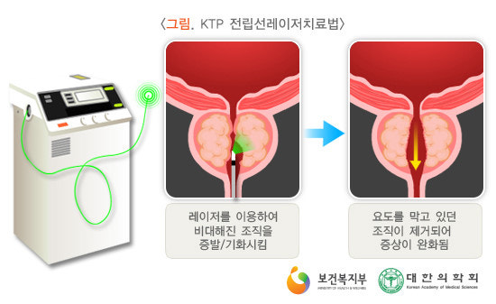 전립선 비대증의 증상 및 원인, 치료방법