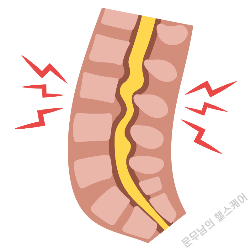 허리 협착증 증상 원인 치료법은?