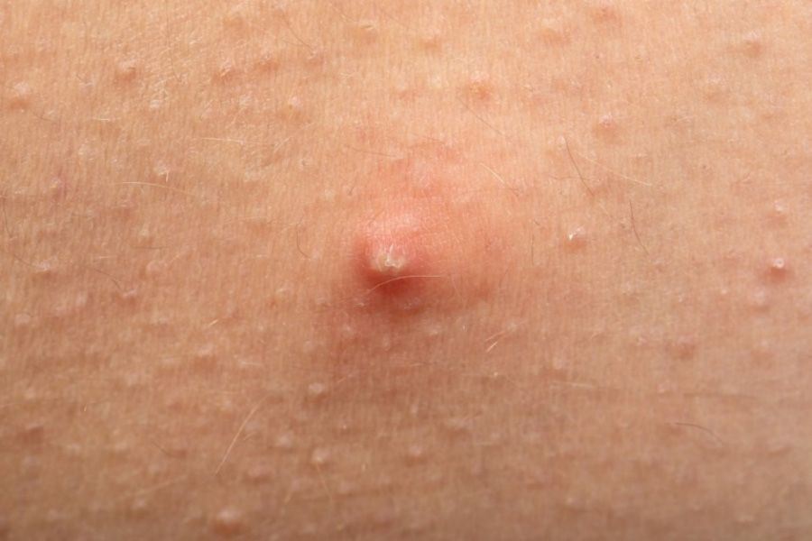 피부에 노란 농이 가득 차 있는 화농성 종기를 확대를 하여 찍은 피부 질환 사진