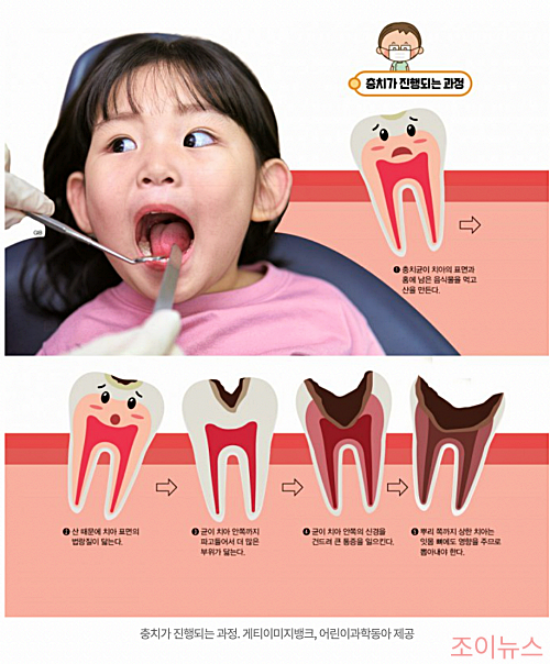 아이들 충치가 발생하는 과정_이미지출처:동아사이언스